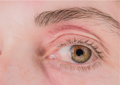 Contraindications and Safety Precautions