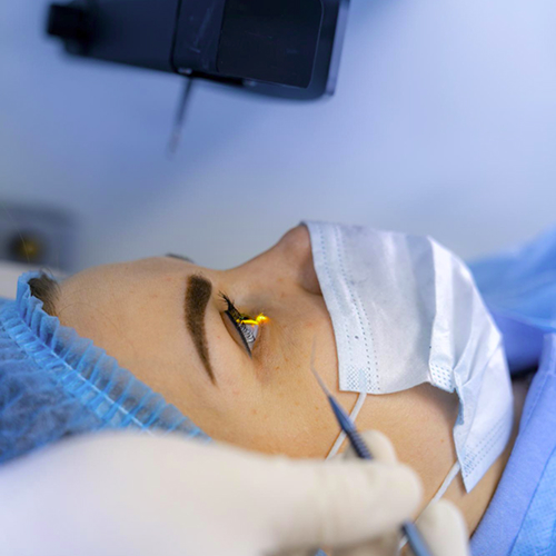 What is posterior lamellar keratoplasty?