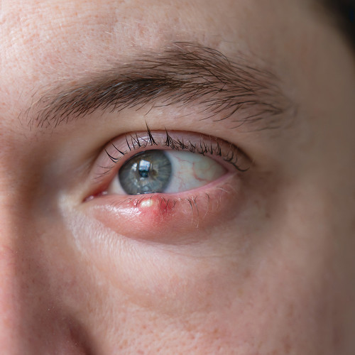 What are eyelid growths and when do they require removal?
