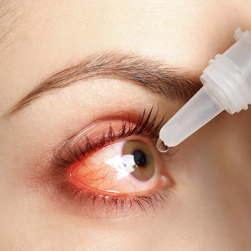 What is a pterygium and why shouldn't it be ignored?