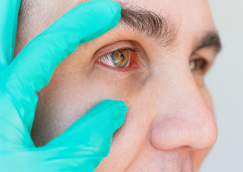 When do we recommend pterygium removal?