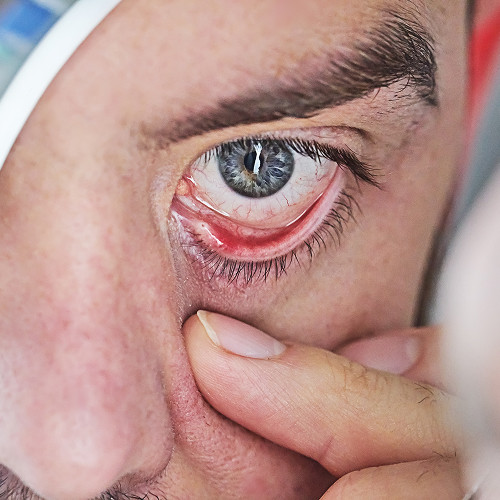 What is a chalazion and why does it appear?