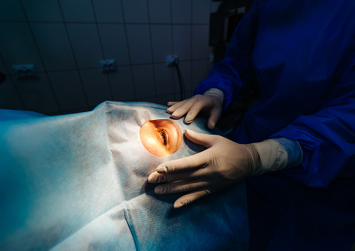 How is a cataract extraction performed?