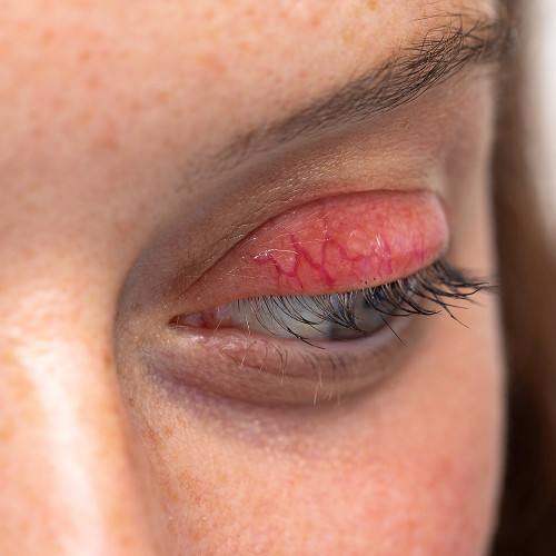 What is blepharitis and why is it dangerous?