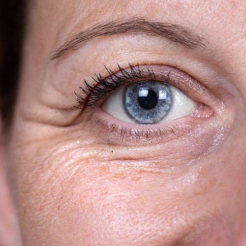 What is blepharochalasis?