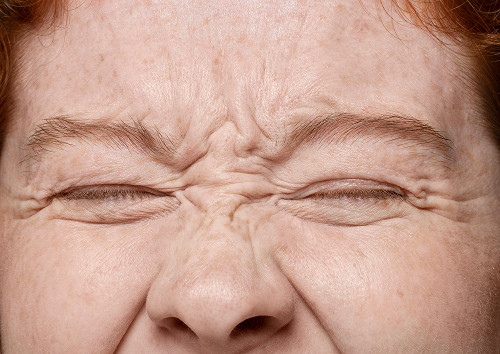 How does blepharochalasis differ from ptosis and dermatochalasis?