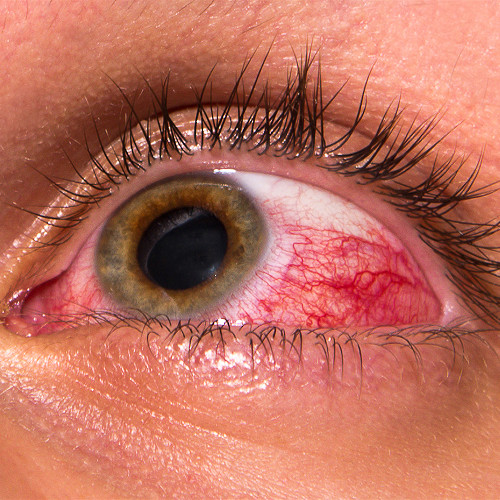What is uveitis and why does it occur?