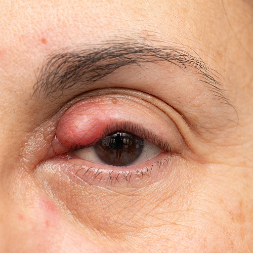 Symptoms of a chalazion
