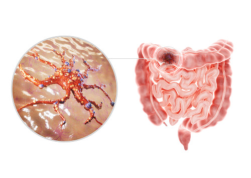 Types of Small Intestinal Cancer