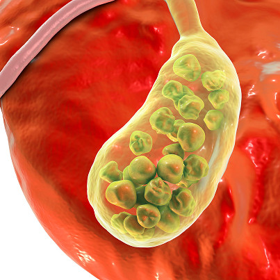 What is gallbladder cancer?