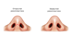 Open and closed rhinoplasty