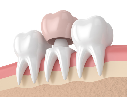 Application of dental crowns