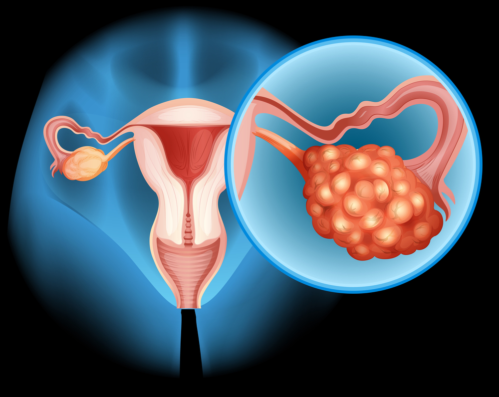 Ovarian cancer treatment