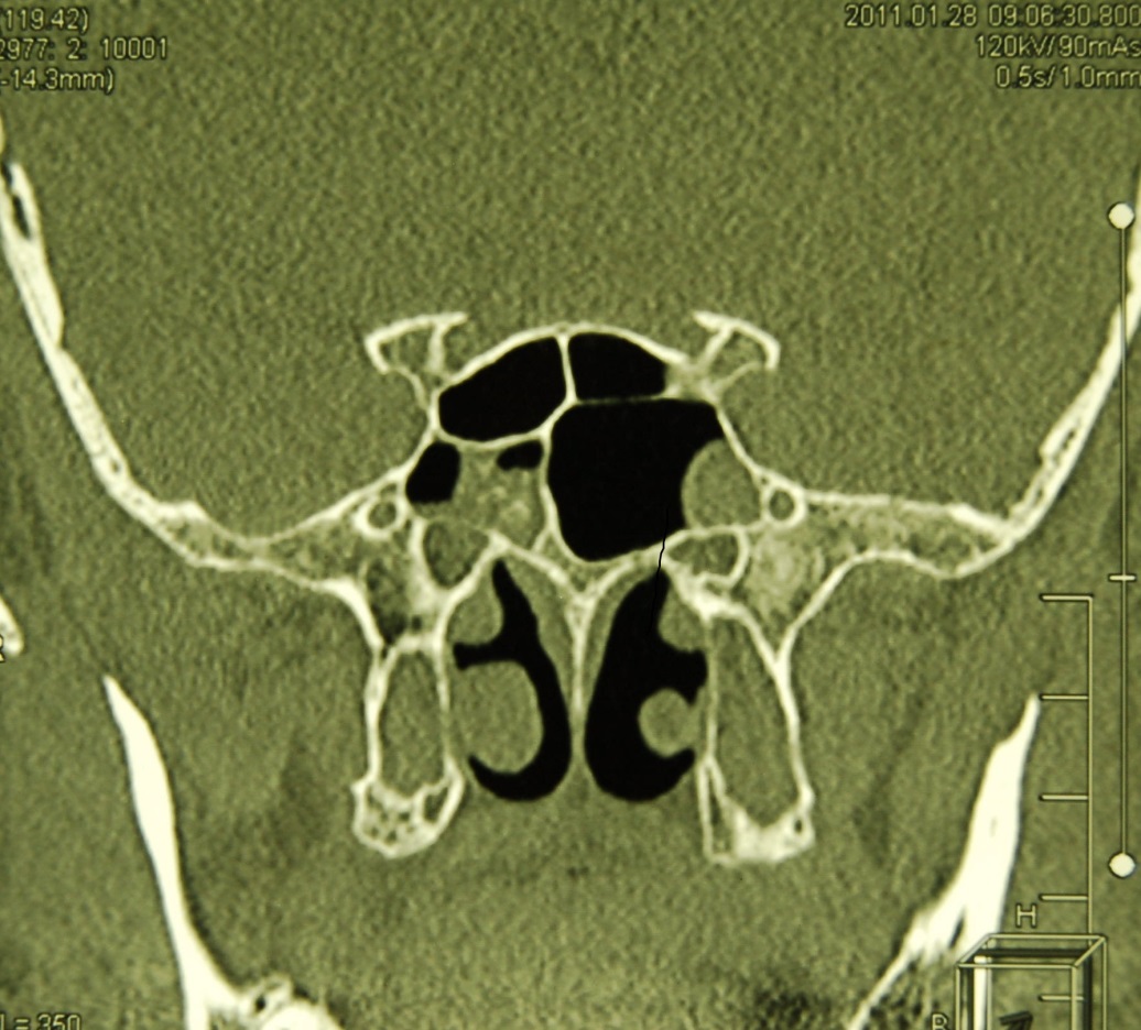 Sphenoiditis treatment - K + 31