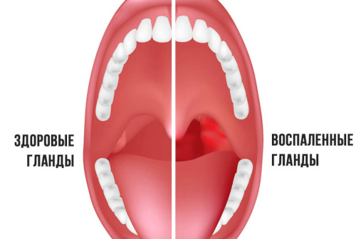 The meaning of tonsillectomy surgery