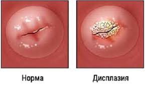 Treatment of vulvar dysplasia