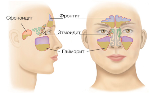 Factors in the development of frontal sinusitis