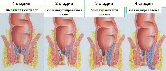 Лечение наружного геморроя