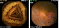 Capsule Endoscopy