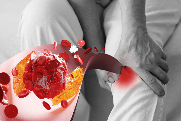 Классификация атеросклероза