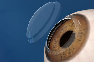 Keratoplasty for eye diseases at the K+31 clinic