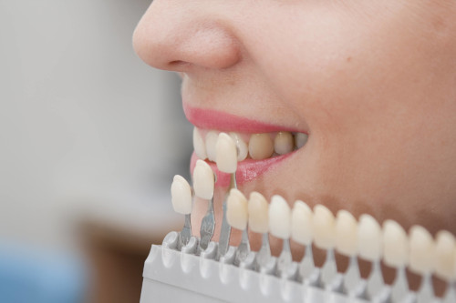 Показания к установке зубного протеза на передние зубы
