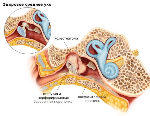 What is ear cholesteatoma and the mechanisms of its development