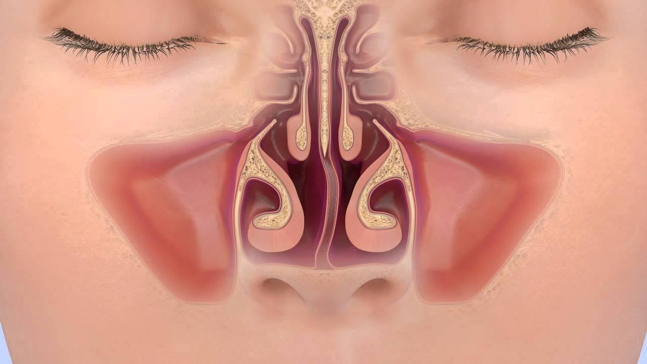 When is revision surgery on the nasal septum necessary?