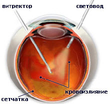 Витреоретинальная хирургия: особенности и преимущества