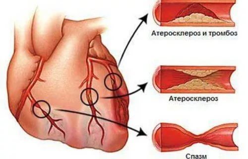 Инфаркт легкого - причины, симптомы, методы лечения