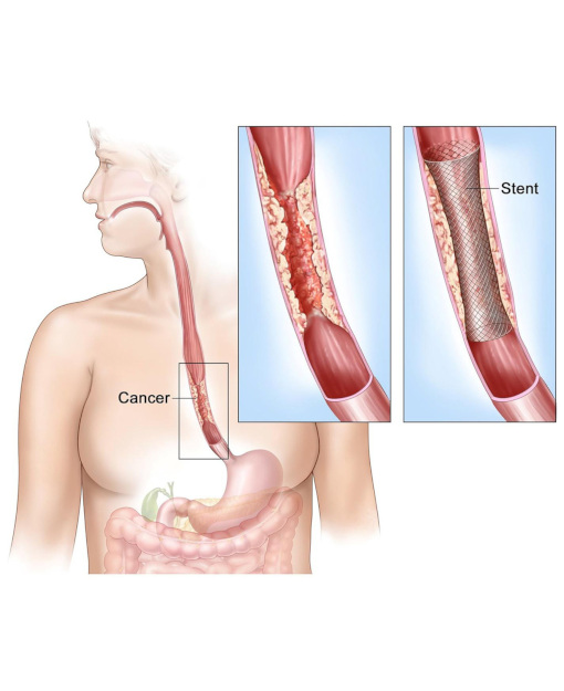 Endoscopic stenting