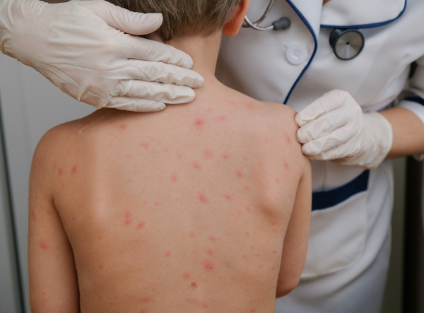 What is chickenpox in children?