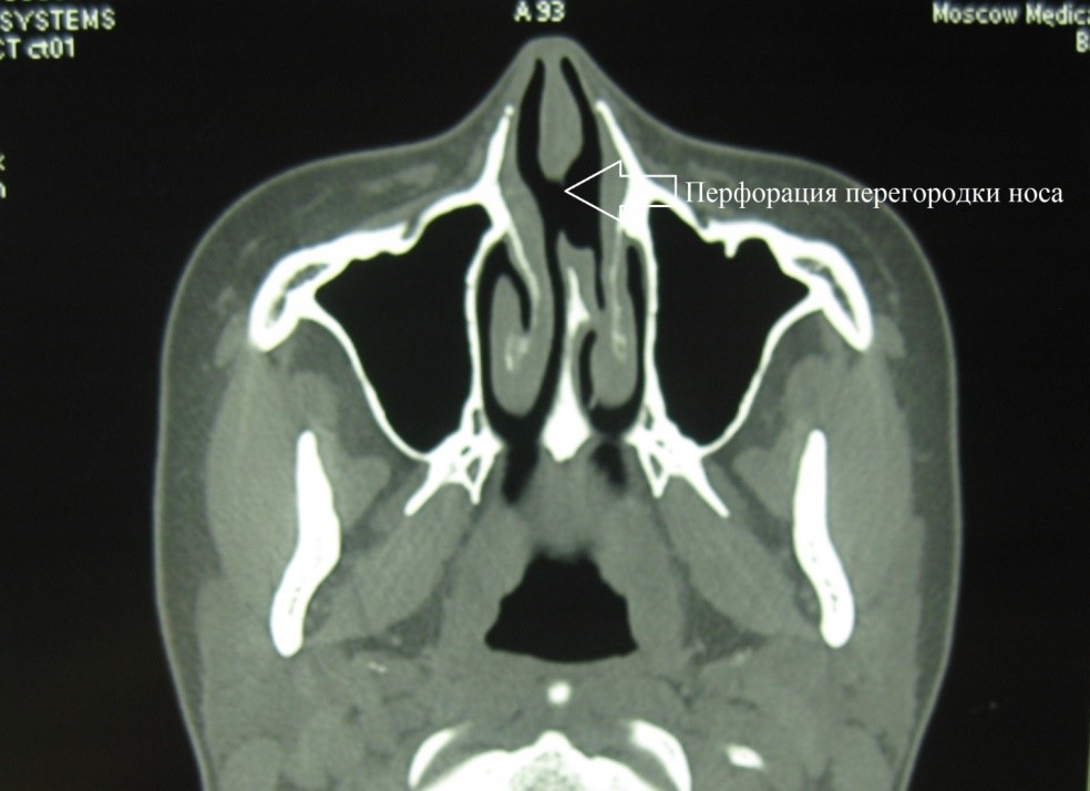 Treatment of perforation of the nasal septum