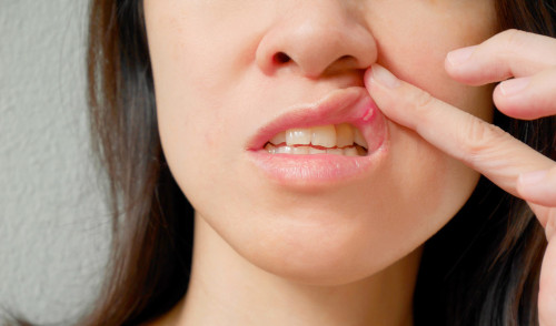 Why does stomatitis appear?