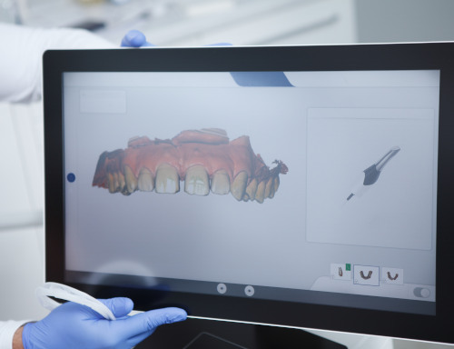 DSD (Digital Smile Design) – computer digital modeling of a smile
