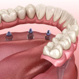 Implant prosthetics: dentures