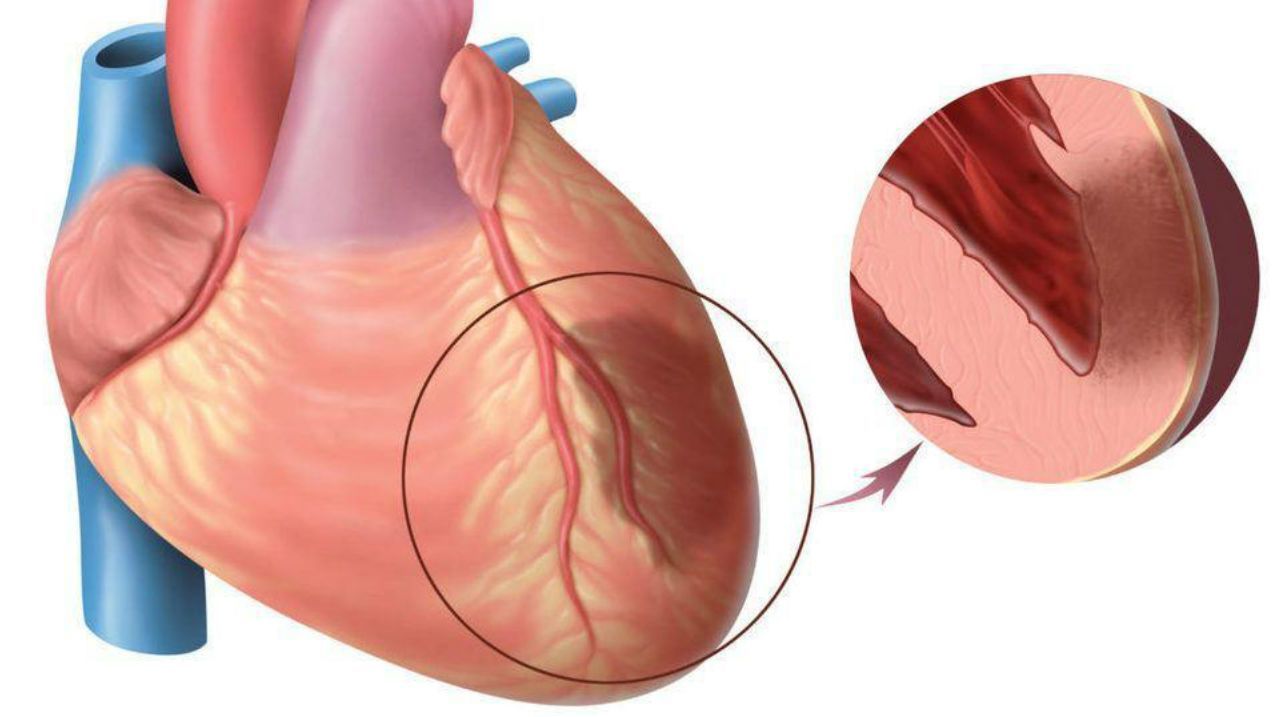 Инфаркт миокарда: первые признаки сердечного приступа, способы лечения и  диагностики