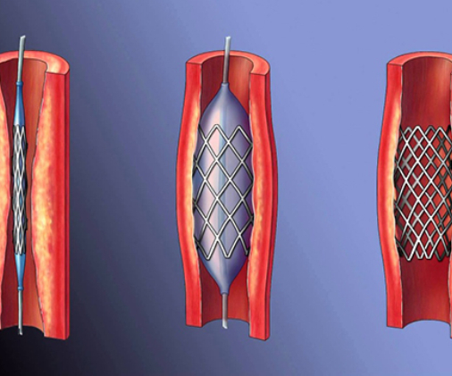 Endovascular Surgery Techniques