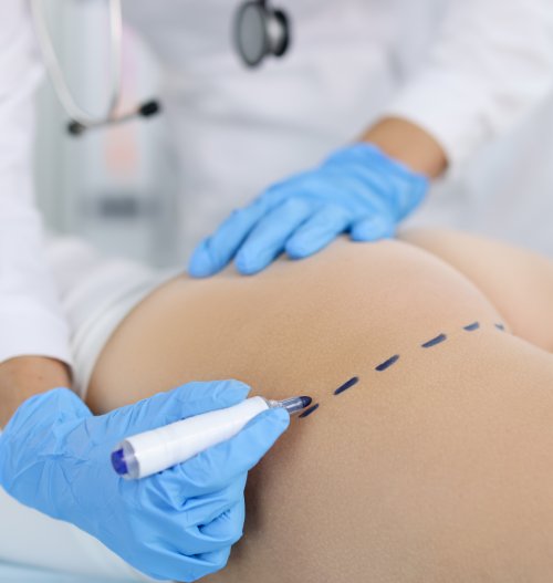 When is buttock plastic surgery necessary?