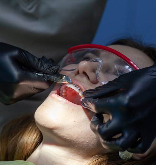 What are vestibular braces?