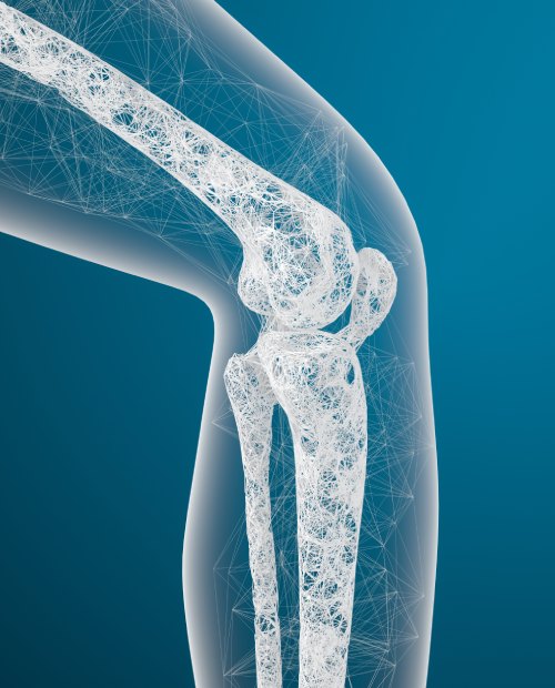 Что такое гонартроз и остеоартроз