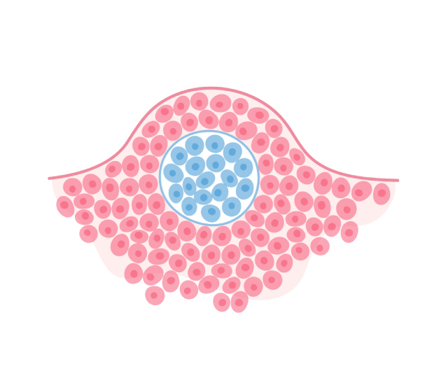 Benign tumor in tissue.  Medical diagram for poster