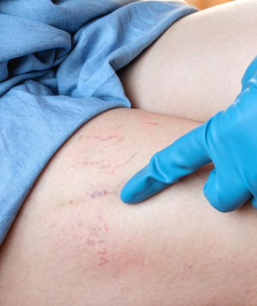 Indications for surgery for varicose veins