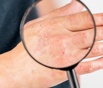 Possible complications of dermatitis