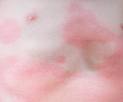 Atopic dermatitis