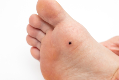 Plantar warts