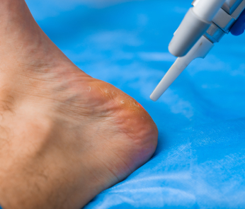 laser removal of plantar warts