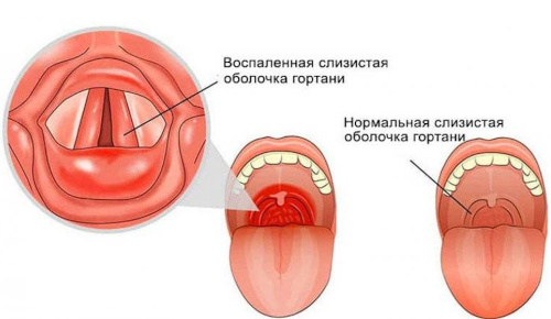 Symptoms of laryngitis