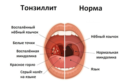Формы тонзиллита