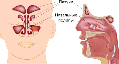 Reasons for the formation of polyps